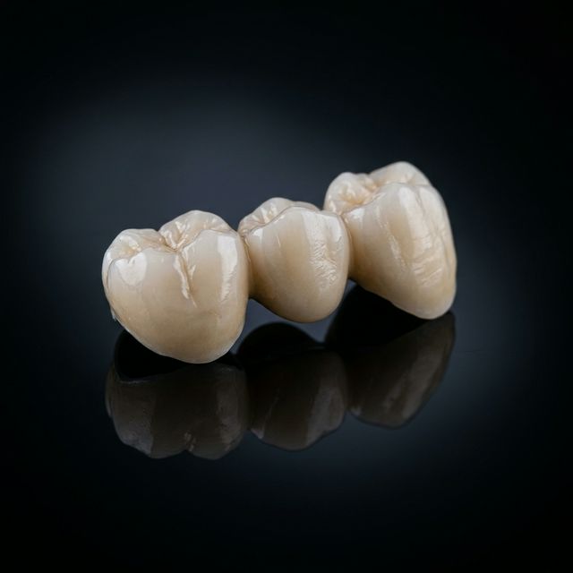 Swiss Restoration – Full Arch dental treatment result at Smile Clinique